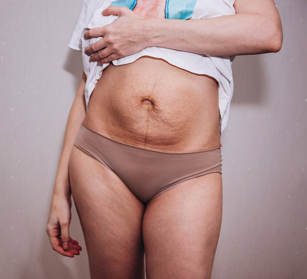 C-Section Scar Massage: Heal with Love